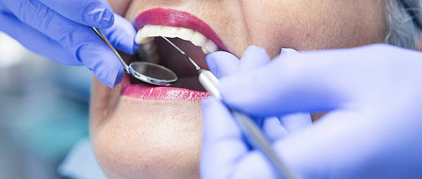 Best Emergency Wisdom Tooth Extraction in Rayville, LA